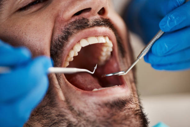 Best Emergency Wisdom Teeth Removal in Stratmoor, CO